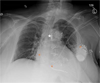 Case Report: Unmasking sustainable left ventricular recovery in chronic heart failure with axillary temporary mechanical circulatory support